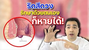 ริดสีดวงรูปจริง